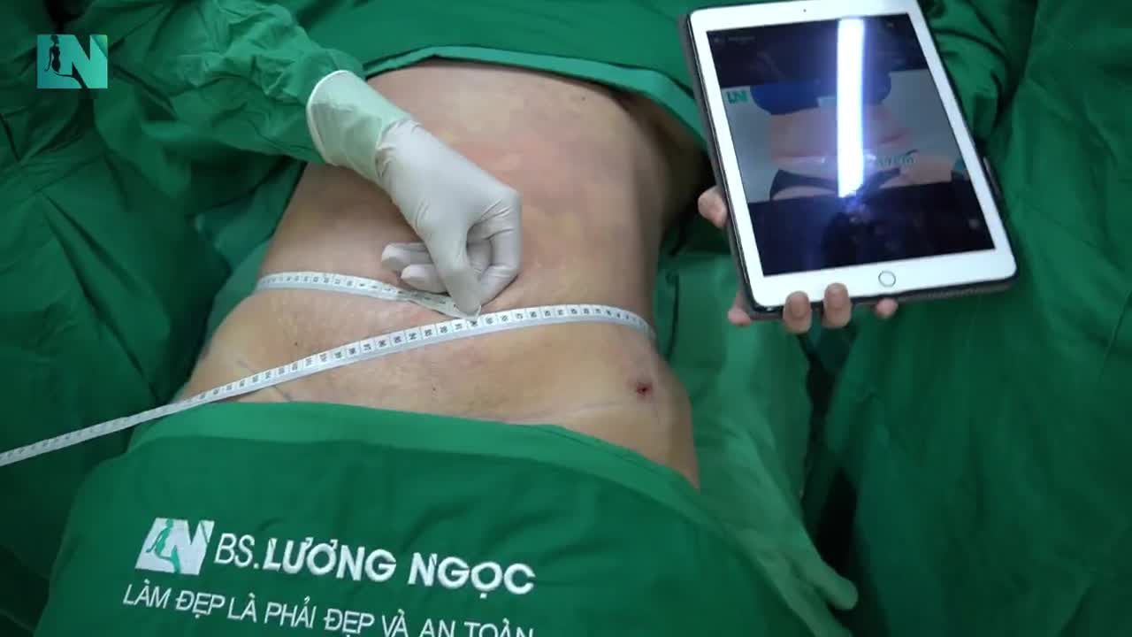 Sẽ thay đổi như thế nào sau ca  hút mỡ tạo dáng thẩm mỹ?
